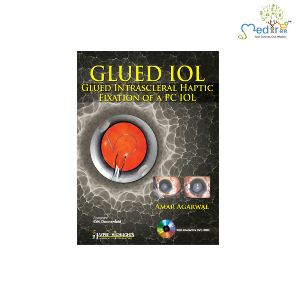 Glued IOL: Glued Intrascleral Haptic Fixation of a PC IOL