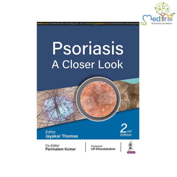 Psoriasis: A Closer Look